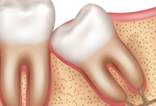 The Mystery of Wisdom Teeth You’ve Been Wondering About