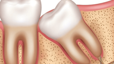 The Mystery of Wisdom Teeth You’ve Been Wondering About