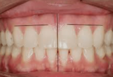 Congenital Dental Corrections: Addressing Missing or Malformed Teeth